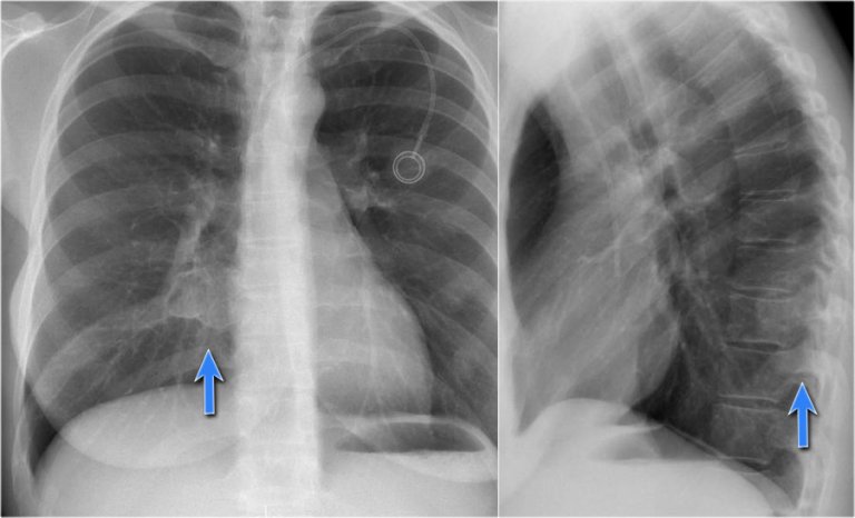 The Radiology Assistant : Chest X-Ray - Basic Interpretation