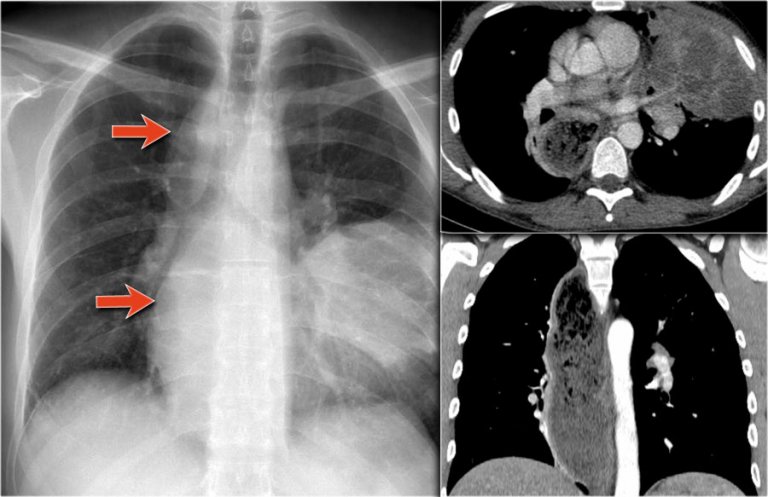 The Radiology Assistant : Chest X-Ray - Basic Interpretation