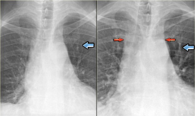 Views of the upper lobe vessels of a patient in good condition (left) and during a period of CHF (right). Notice also the increased width of the vascular pedicle (red arrows).