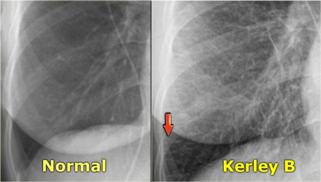 LEFT: normal. RIGHT: CHF stage II with Kerley B-lines due to interstitial edema