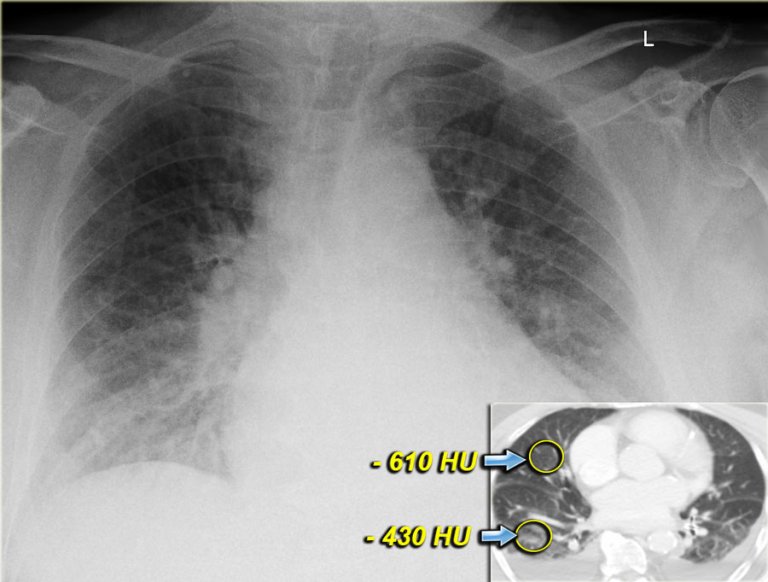 Heart Failure Chest X Ray