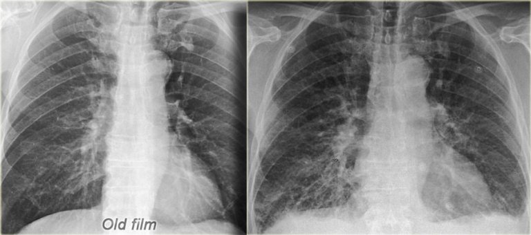 The Radiology Assistant : Chest X-Ray - Heart Failure