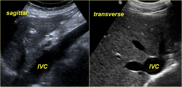 Dilatation of IVC and hepatic veins on US images in a patient with RV failure