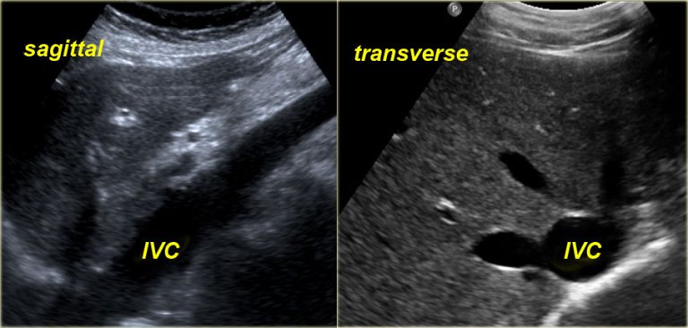 Hvc Radiograph The Radiology Assistant : Chest X-Ray - Heart Failure