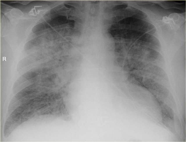 Heart failure with diffuse perihilar pulmonary edema