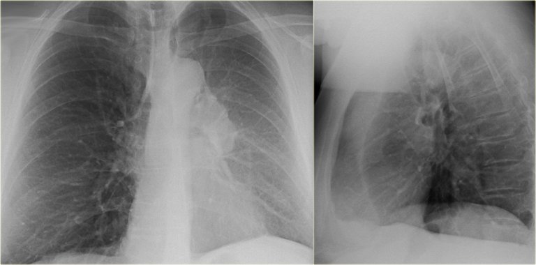 The Radiology Assistant : Chest X-Ray - Lung disease