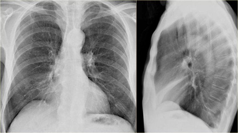 The Radiology Assistant : Chest X-Ray - Lung disease