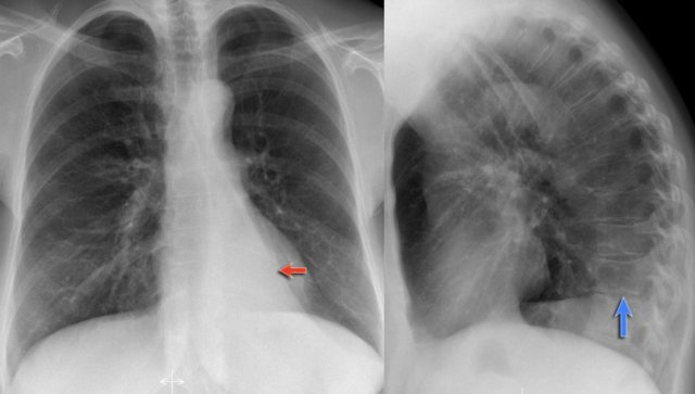 The Radiology Assistant : Chest X-Ray - Lung disease