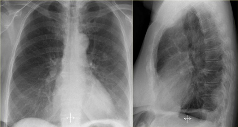 The Radiology Assistant : Chest X-Ray - Lung disease