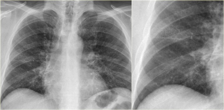 The Radiology Assistant : Chest X-Ray - Lung disease