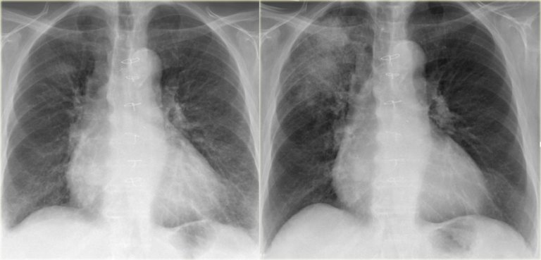 The Radiology Assistant Chest X Ray Lung Disease