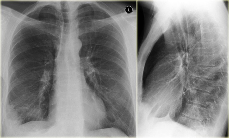 Healthy Lung Chest X Ray