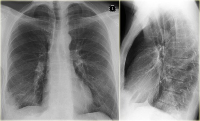 Lunginfarction due to pulmonary emboli