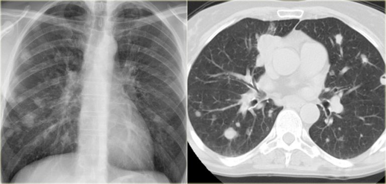 The Radiology Assistant : Chest X-Ray - Lung disease