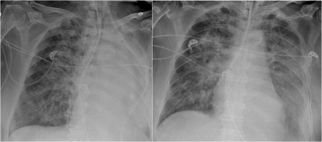 Total atelectasis in a patient with severe bronchopneumonia.
