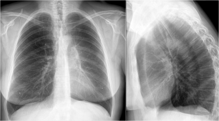 The Radiology Assistant : Chest X-Ray - Lung disease