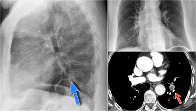 Plate-like atelectasis in a patient with pulmonary embolism