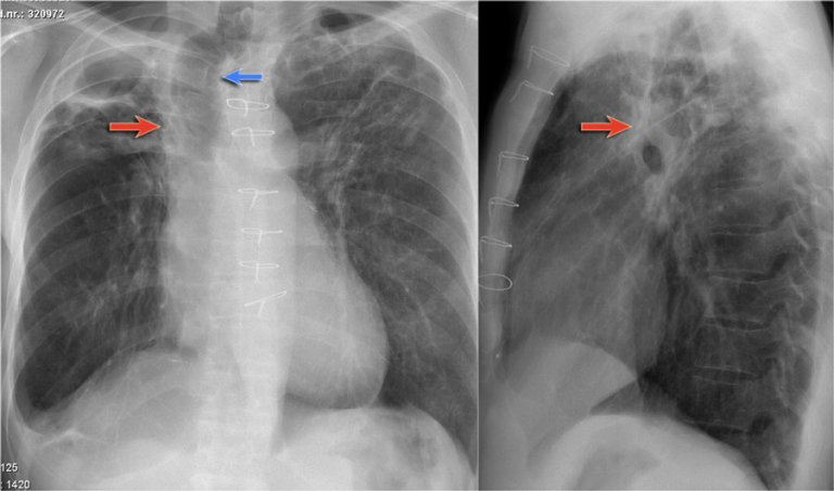 The Radiology Assistant : Chest X-Ray - Lung disease