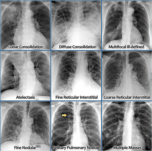 abnormal chest x ray images