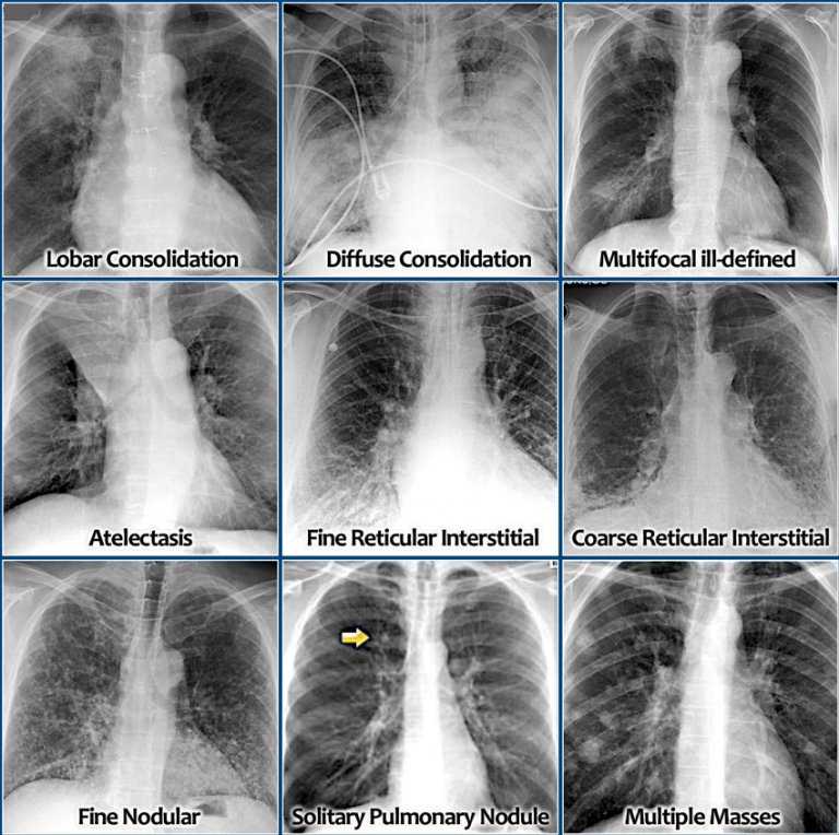 The Radiology Assistant Chest XRay Lung disease