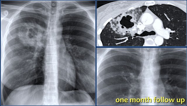 Pneumonia with cavitation
