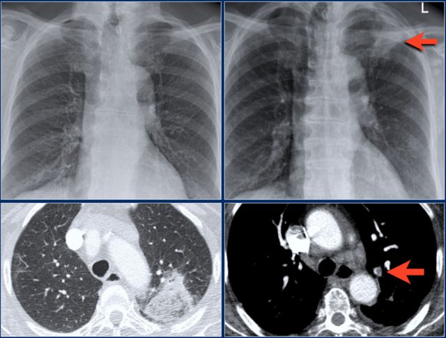 Pulmonary embolism resulting in an infarcted area.