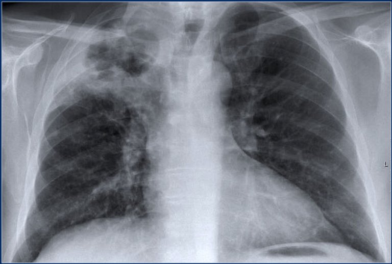 The Radiology Assistant Chest X Ray Lung Disease