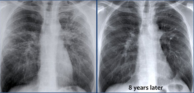 The Radiology Assistant : Chest X-ray - Lung Disease