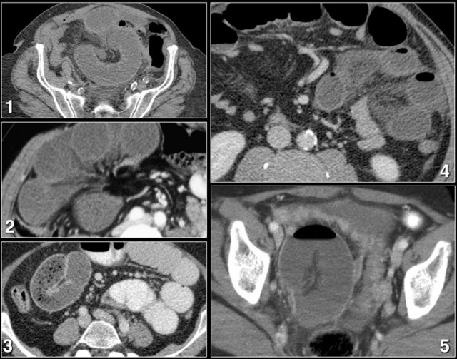 Odd configuration of small bowel loops in patients with a closed loop obstruction