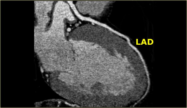 CT image of the LAD in RAO projection