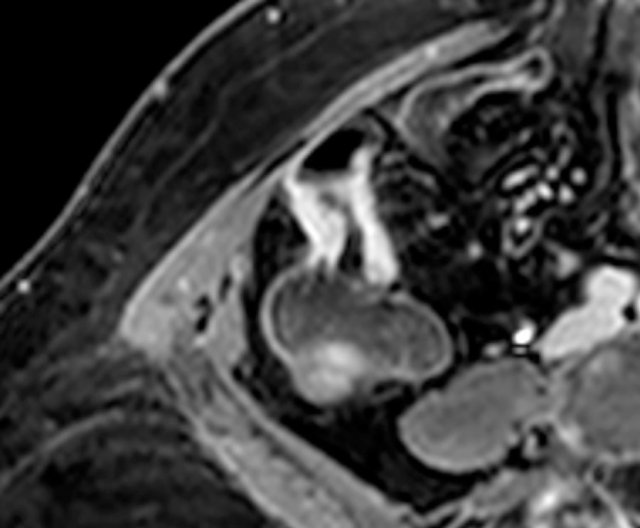 Thickened terminal ileum segment with marked enhancement on axial post-contrast T1W image  with fatsat.