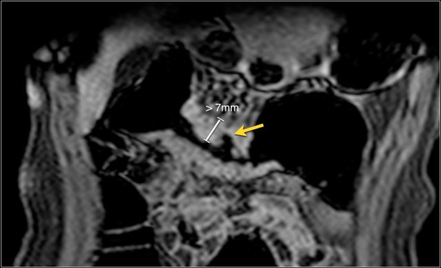 Bowel wall thickening with deep ulceration (arrow) in the transverse colon.