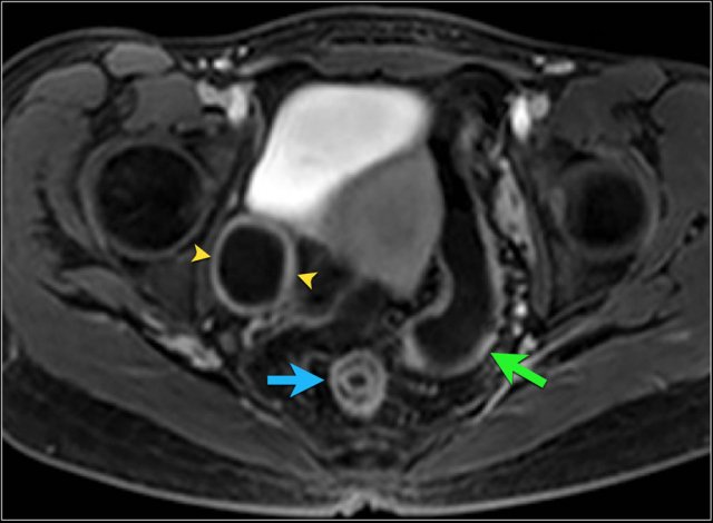 Layered enhancement pattern of the rectum with some surrounding fat stranding on an axial post-contrast T1 image (arrow). Continued inflammation with a homogeneous enhancement pattern can be seen in the sigmoid colon (green arrow). Also, a right-sided adnexal cyst is present with enhancing rim (arrowheads).