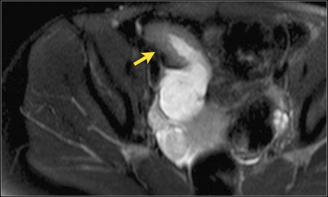 Inflamed small bowel showing wall thickening and mild mural T2 signal (arrow) on an axial T2 with fat sat. Prestenotic dilatation can be seen proximally of the diseased segment.