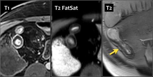 Wall thickening of the terminal ileum in a 67-year-old male with Crohn's disease since 11 years. Layered enhancement is seen on an axial post-contrast T1 image with fat sat (left). T2 with fat sat (middle) shows the same pattern with a middle layer of low intensity. T2 without fat sat shows an increased signal in the middle layer, suggesting fat depositions. Endoscopy showed only superficial disease.