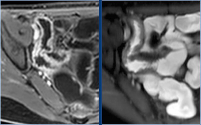 Coronal post-contrast T1 and T2 fat sat images show multiple small ulcerations in the terminal ileum.