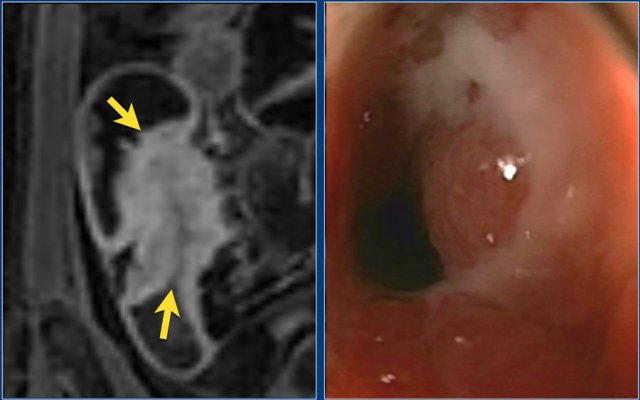 Coronal post-contrast T1 image with a stenosis at the ileocecal junction (left). No obvious pre-stenotic dilatation is seen.  The stenosis was non-passable using endoscopy (right).