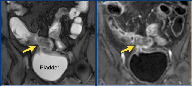 Coronal Balanced FFE image shows an enterovesical fistula (arrow) originating from the small bowel. Post-contrast T1 image shows marked enhancement of the small bowel and the 'tram track' at the site of the fistula.