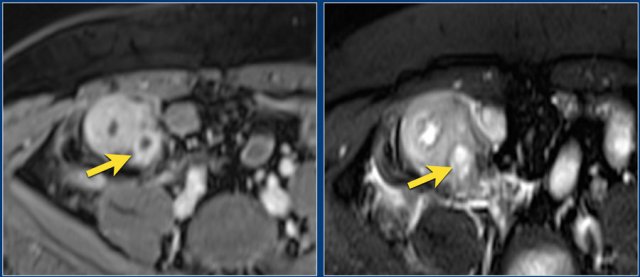 Small abscess medioposterior from thickened and inflamed terminal ileum. Note the rim enhancement on the post-contrast T1 image (upper) and marked mural signal on the fat sat T2 image (lower)