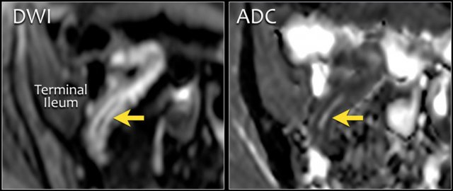 Crohn's disease of the terminal ileum with high signal on axial DWI and low signal on ADC map indicating diffusion restriction (b=600).