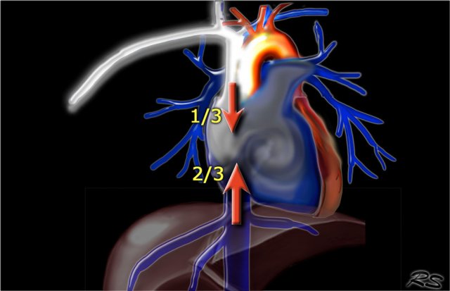 Transient Interruption of Contrast: Deep inspiration results in dilution of contrast in the right atrium by unopacified blood from the inferior vena cava.