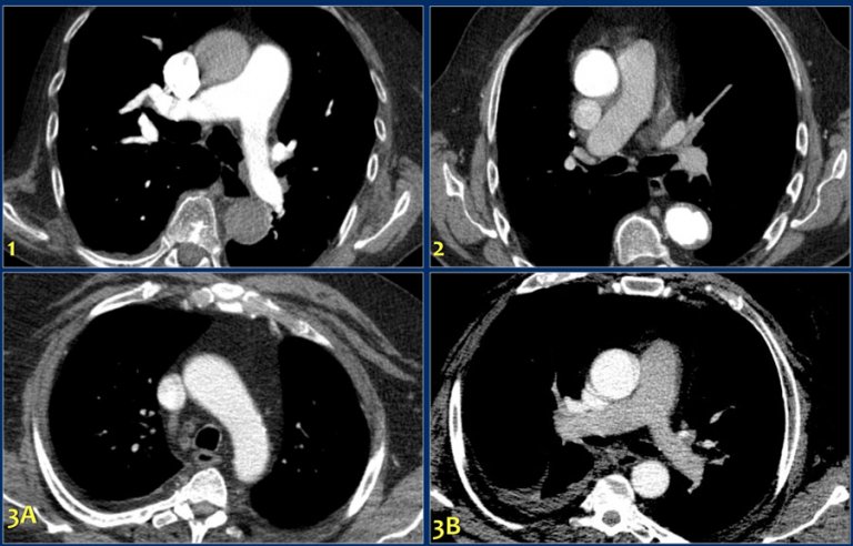 The Radiology Assistant : CT contrast injection and protocols