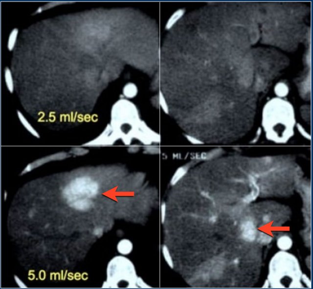 Patient with liver cirrhosis and multifocal HCC injected at 2.5ml/sec (left) and at 5ml/sec (right)