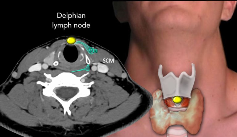 The Radiology Assistant : Cervical Lymph Node Map