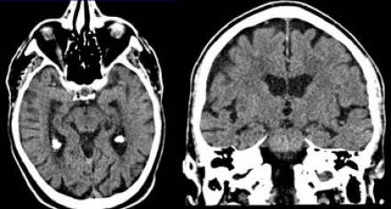 The Radiology Assistant Brain Dementia Role Of Mri