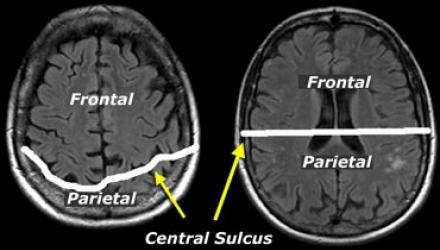 The Radiology Assistant Brain Dementia Role Of Mri