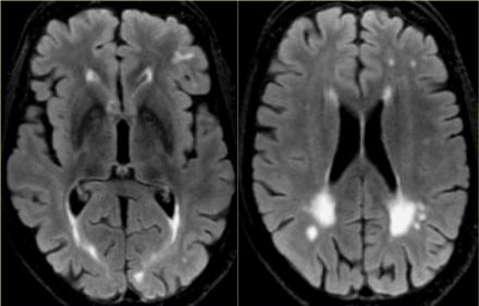 The Radiology Assistant : Brain - Dementia: Role of MRI