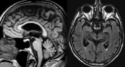 The Radiology Assistant Brain Dementia Role Of Mri