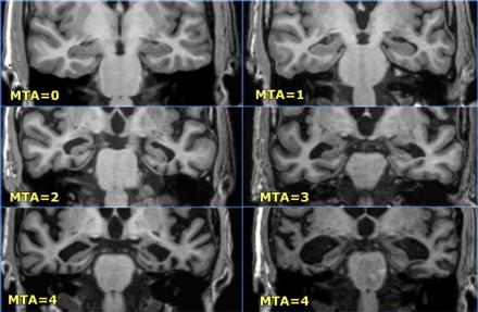 The Radiology Assistant : Brain - Dementia: Role of MRI