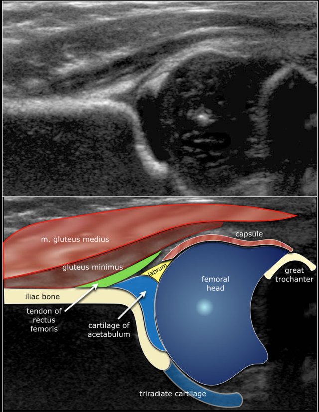 transverse presentation hip ultrasound